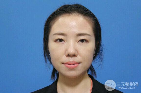 北京膨体隆鼻