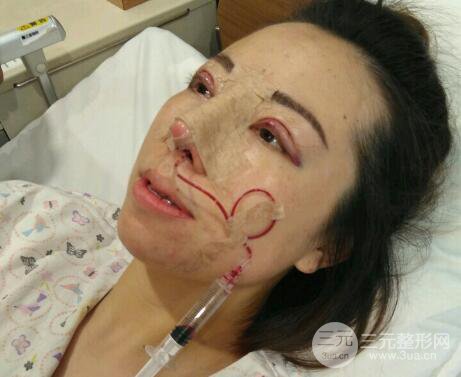 北京膨体隆鼻