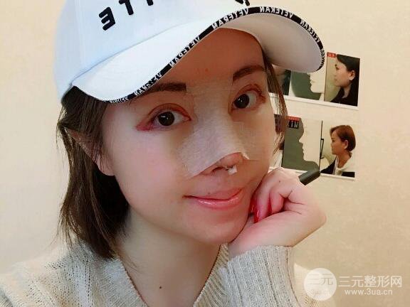 北京膨体隆鼻