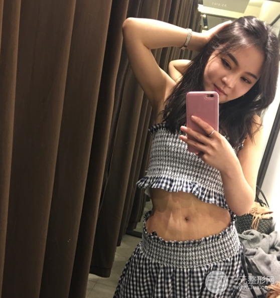 水动力吸脂术