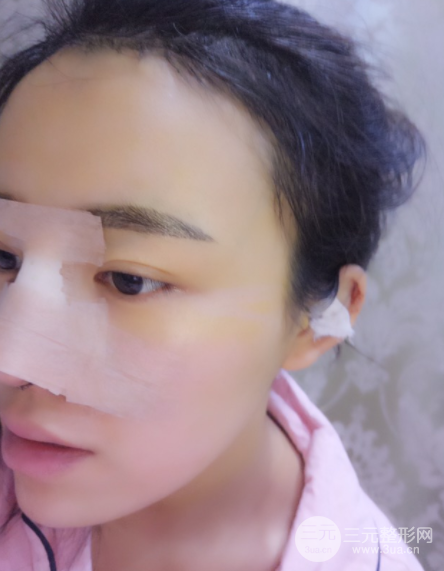 分段式假体隆鼻