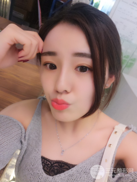分段式假体隆鼻