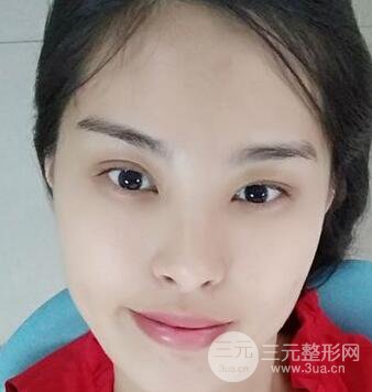 美容冠矫正龅牙