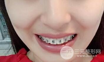 美容冠矫正龅牙