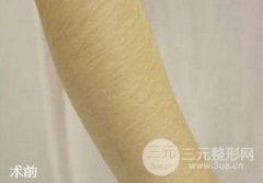 夏季将至莱西尔脱毛让我清爽度过整个夏季