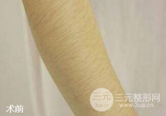 莱西尔脱毛