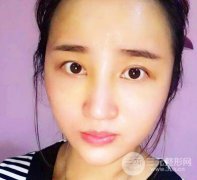 上海九院自体脂肪填充额头33天真实果图分享 上海九院自体脂肪填充额头33天真实果图分享