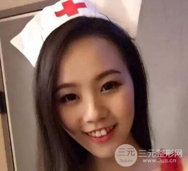 注射玻尿酸丰下巴