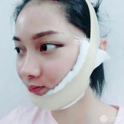 上海九院面部吸脂100天真实案例果图分享