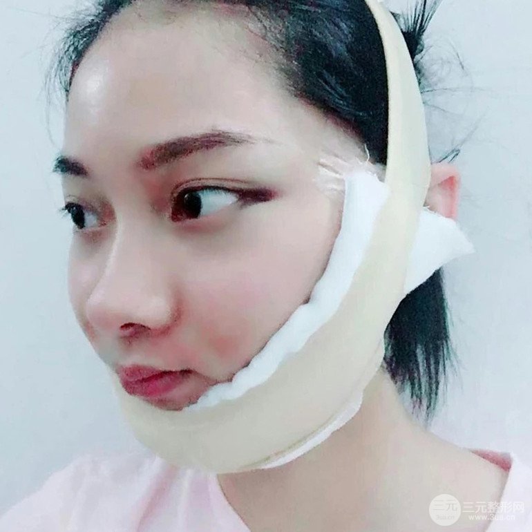 面部吸脂