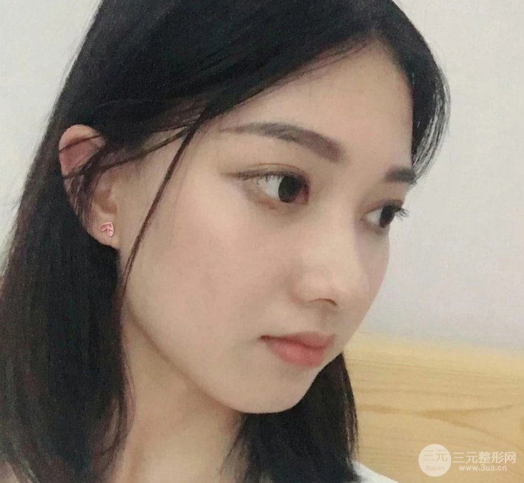 面部吸脂