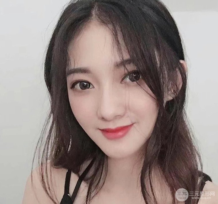 面部吸脂