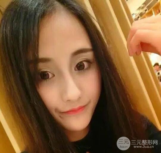 北京伊美尔何祯平做完双眼皮