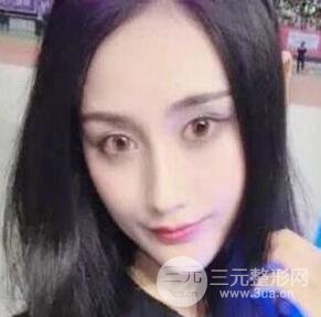 北京伊美尔何祯平做完双眼皮