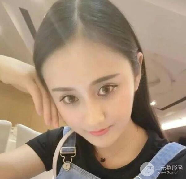 北京伊美尔何祯平做完双眼皮