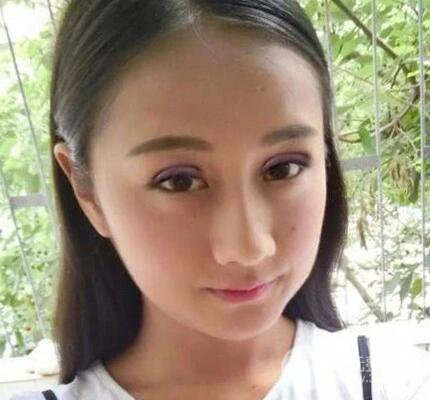 北京伊美尔何祯平做完双眼皮