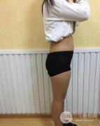 上海九院大腿吸脂减肥术后3个月的变化太惊人啦