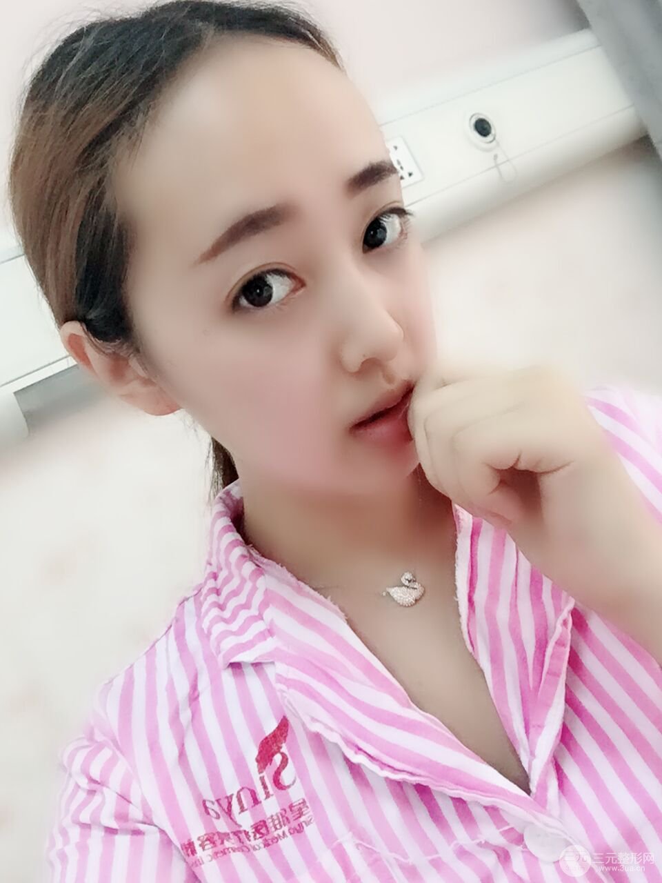 北京八大处李发成做完详细部吸脂