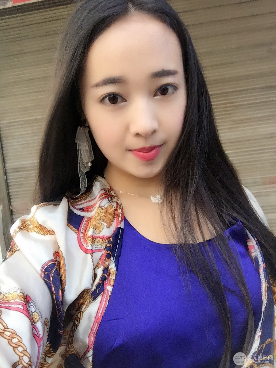 北京八大处李发成做完详细部吸脂