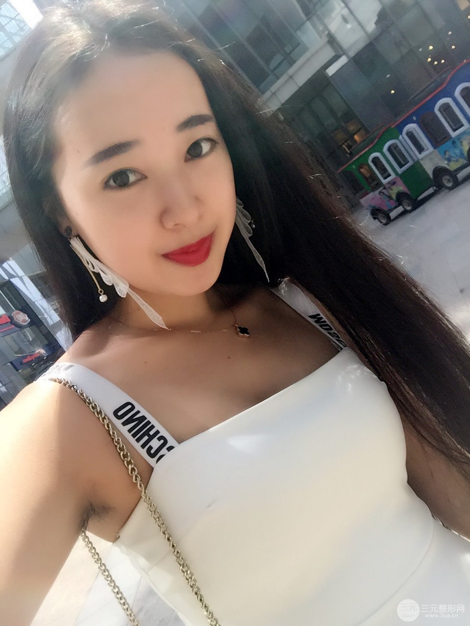 北京八大处李发成做完详细部吸脂