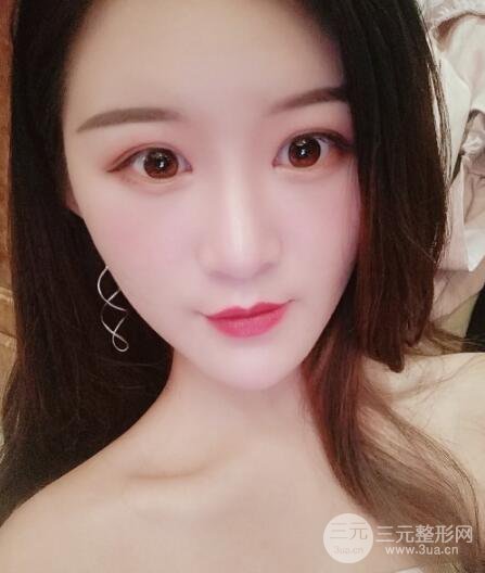 上海伊莱美医疗美容医院立秀膨体隆鼻果