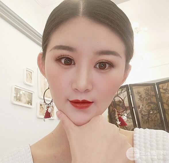 上海伊莱美医疗美容医院立秀膨体隆鼻果