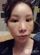 长良医疗美容脂肪填充全脸33天真人果图对比照分享 长良医疗美容脂肪填充全脸33天真人果图对比照分享