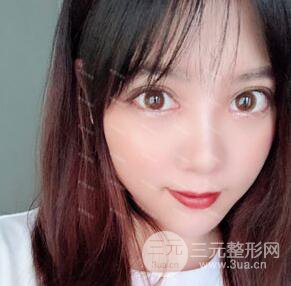 开内眼角