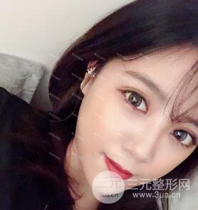 开内眼角