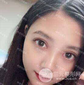 开内眼角