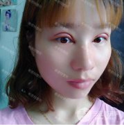 武汉希思特整形医院双眼皮修复前后对比照 术后84天 告别一单一内双不对称