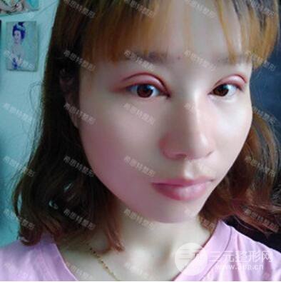 双眼皮修复前后