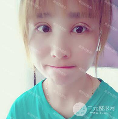 双眼皮修复前后