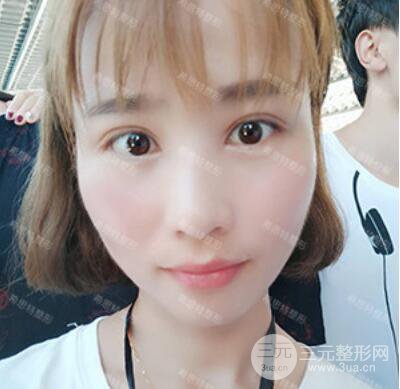 双眼皮修复前后