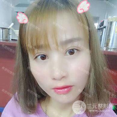 双眼皮修复前后