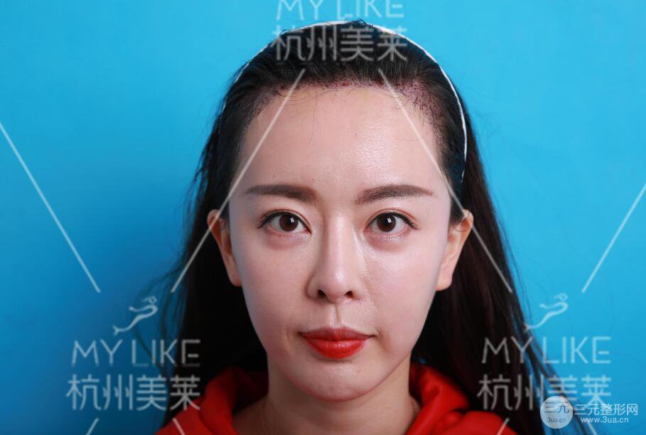 杭州美莱发际线种植