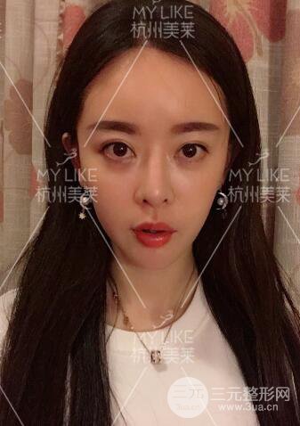 杭州美莱发际线种植