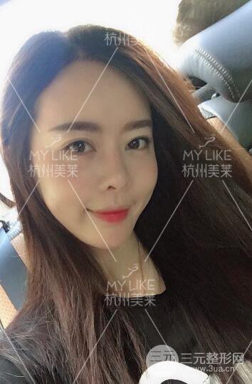 杭州美莱发际线种植
