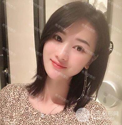 双眼皮