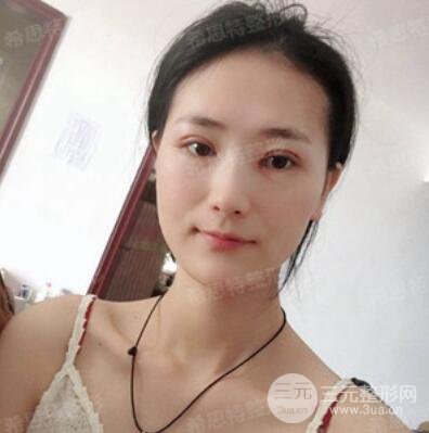 双眼皮