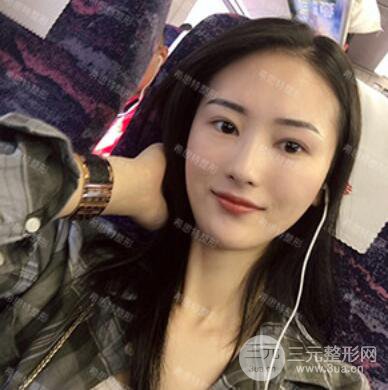 双眼皮