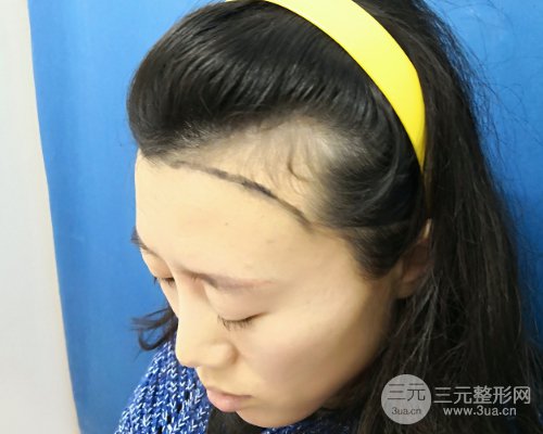 【植发际线案例展示】