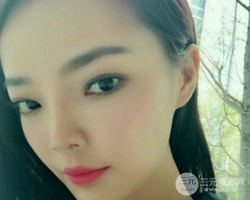 【埋线提升案例展示】