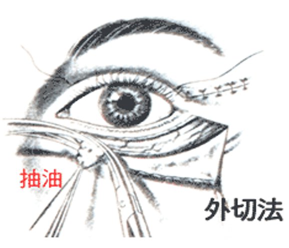 祛眼袋有几种方法 需要多久能恢复