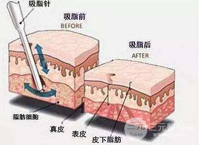 如何吸脂瘦腿 吸脂瘦腿方法有哪些