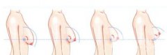 乳房下垂造成的原因？乳房下垂怎么矫正