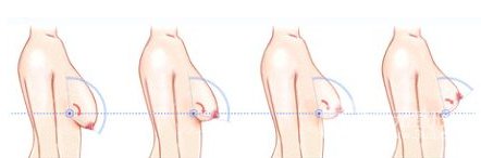 乳房下垂造成的原因?乳房下垂怎么矫正