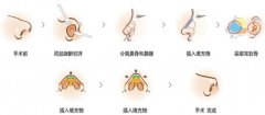 做硅胶隆鼻注意事项有哪些? 硅胶隆鼻手术图片