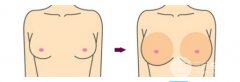 自体脂肪隆胸和假哪体隆胸个果好?