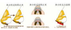 鼻小柱延长怎么做  鼻小柱延长用什么材料